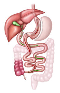 Duodenal Switch Oxnard | Bariatric Surgery Simi Valley | University Bariatrics