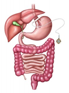 Gastric Band Bariatric Surgery Oxnard | Adjustable Band Thousand Oaks | University Bariatrics