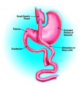Gastric Bypass Thousand Oaks
