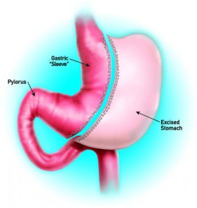Sleeve Gastrectomy Oxnard | University Bariatrics Thousand Oaks